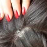 Cómo detener la caída del cabello debido a la caspa