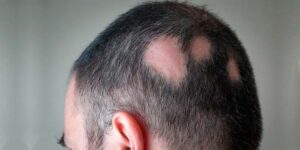 Cuidado de Cabello 22 caida del cabello por estres tratamiento