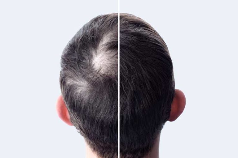 Aumenta el volumen y el cuerpo de tu cabello: consejos para cabello debilitado 2 aumenta el volumen y el cuerpo de tu cabello consejos para cabello debilitado